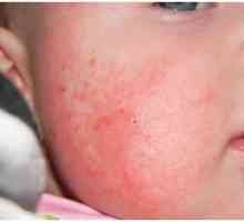 Алергия на сладки бебета