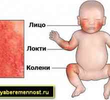 Атопичен дерматит при деца