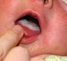 Бели петна по езика на новороденото