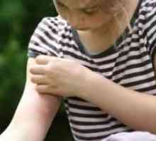 Than за лечение на ухапване от комар при деца?