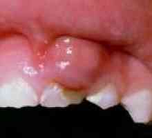 Какво е киста на венците