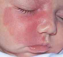 Хемангиоми и невус при новородени