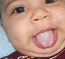 Как за лечение на гъбична инфекция в устата на дете?