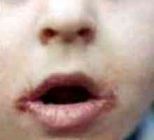 Как за лечение на perleches върху устните на детето