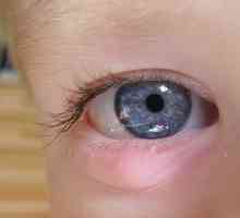 Как правилно и безопасно да се лекува ечемик на окото на детето