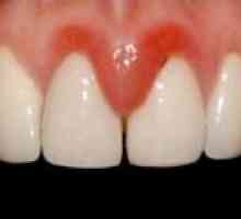 Как да премахнете възпаление на венците около зъба