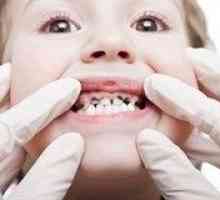Зъбният кариес при децата - лечение и профилактика