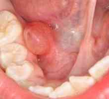 Киста в устата - причини за формирането, симптоми и лечение