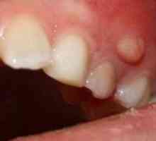 Четки за зъби: причини, симптоми, лечение