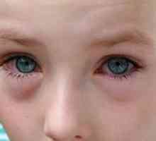 Конюнктивит (възпаление на очите) при деца. Причини, симптоми, лечение и профилактика
