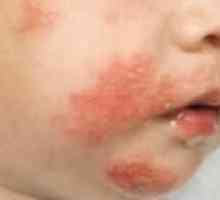 Контактен дерматит при деца