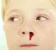 Кървенето от носа при децата