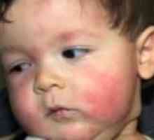 Лечение на хранителни алергии при децата