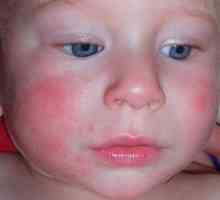 Лечение на различни форми на дерматит при бебета