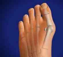 Методи за лечение и отстраняване на костите на крака