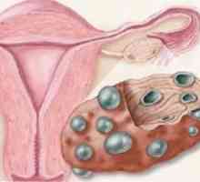 Multifollikulyarnye яйчниците и бременност