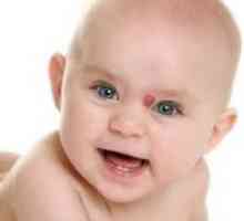 Пигментни родилни петна в новородени бебета