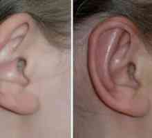 Пластмасови ушите. Корекция на уши