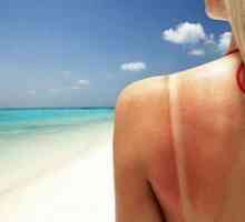 Помогнете със слънчеви изгаряния на кожата