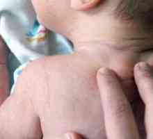 Sudamen бебе - глоба червен обрив по кожата