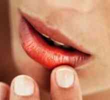 Причини и лечение на пукнатини в ъглите на устата