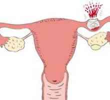 Причини и симптоми на извънматочна бременност