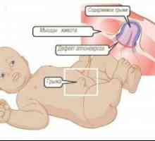 Пъпна херния при бебета - sipmtomy и лечение