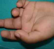 Ревматоиден артрит: причинява при деца