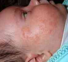 Симптоми и лечение на атопичен дерматит при деца