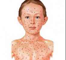 Симптомите на рубеола при децата
