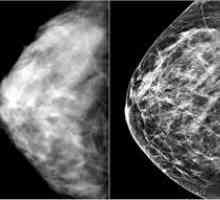Симптомите на рак на гърдата и методи за ранна диагностика на болестта