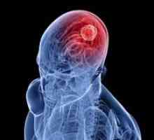 Симптомите на рак на мозъка