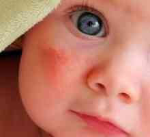 Трябва ли да се страхуваме от червени петна по лицето на новороденото?