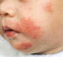 Видове дерматологични заболявания при децата