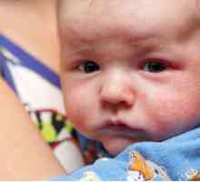 Зиртек - лек за алергии за бебета