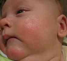 Стафилококус ауреус при новородени
