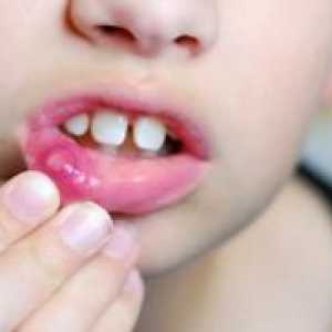 Афтозен стоматит при децата - Лечение