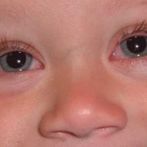 Алергичен конюнктивит при деца. Симптоми и лечение