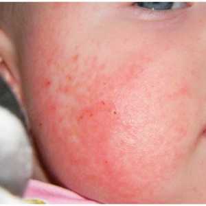 Алергия на сладки бебета