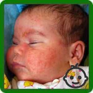 Алергия към слее бебета