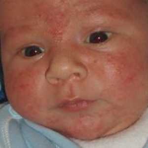 Алергии при бебетата