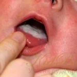 Бели петна по езика на новороденото