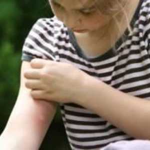 Than за лечение на ухапване от комар при деца?