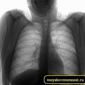 Рентгенография на гръдния кош по време на бременност