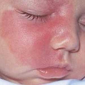 Хемангиоми и невус при новородени