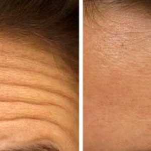 Как да се отървем от дълбоки бръчки по лицето на челото
