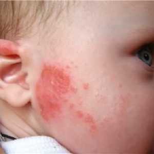 Как алергия при децата?