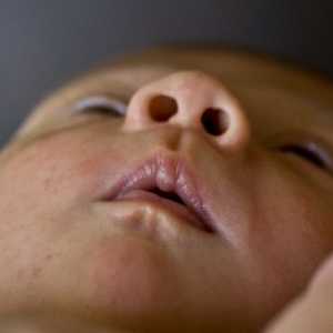 Как да се лекува предразположение на организма на кожата при бебета?