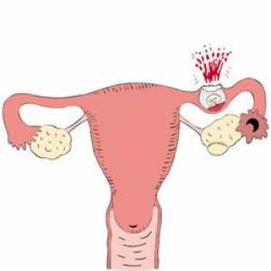 Какви са признаците на извънматочна бременност, една жена трябва да знае?