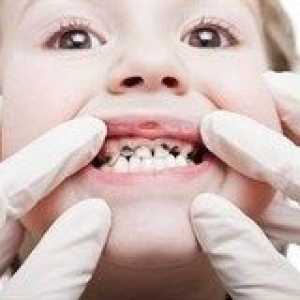 Зъбният кариес при децата - лечение и профилактика